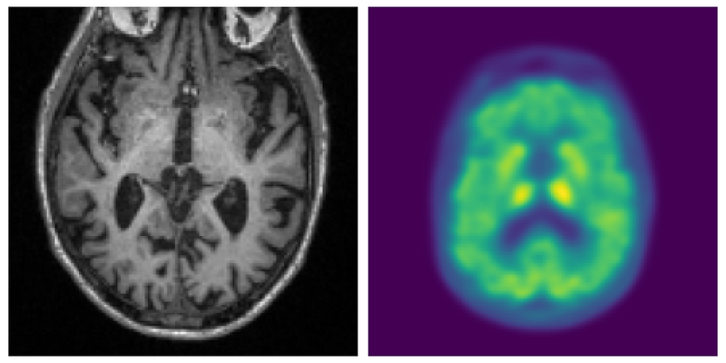 Examples of an MRI (on the left) and a PET scan (on the right).