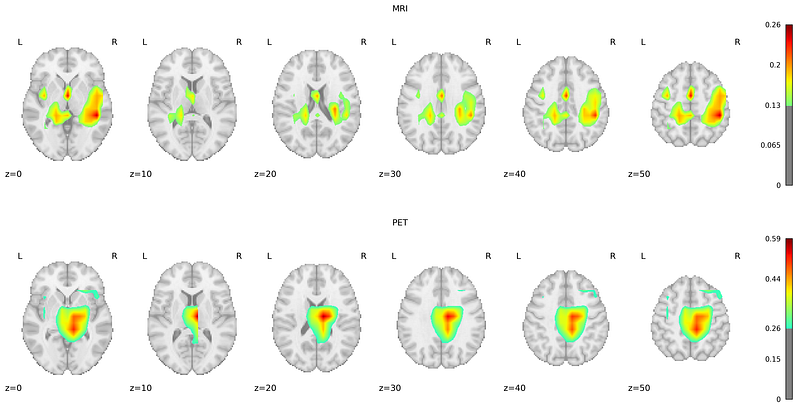 Three-dimensional visualizations created from multiple axial brain slices, showcasing Grad-CAM heatmaps for the positive class.